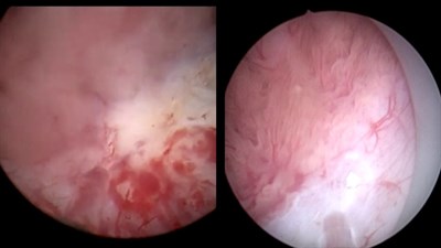Тулиевый и гольмиевый лазер в лечении урологических заболеваний